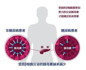 胰島細胞薄膜化有望根治糖尿病